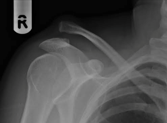 Sports Injury Bulletin - Masterclass - Masterclass: AC joint