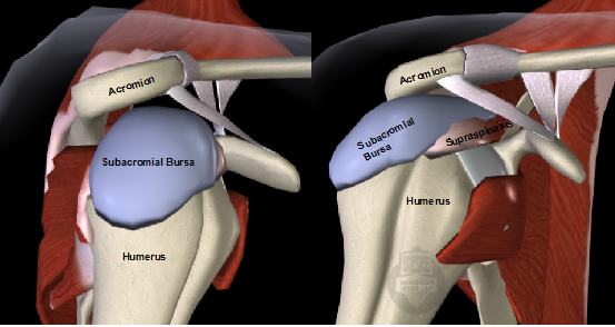 torn bursa sac in shoulder