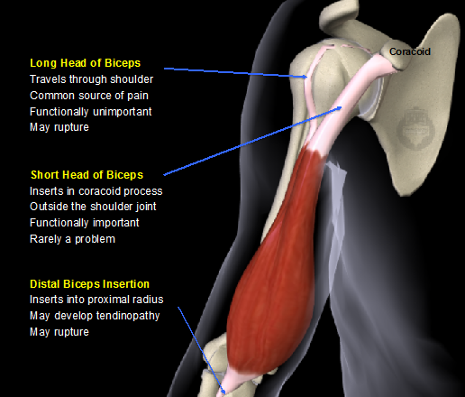 Biceps Tendonitis Causes and Symptoms - Sinew Therapeutics